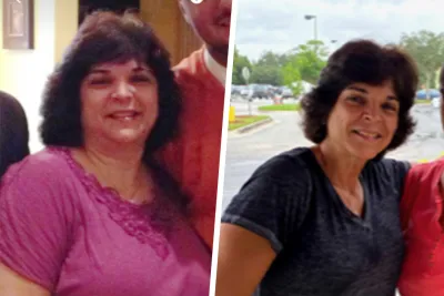 Ellen Before and After Bariatrics