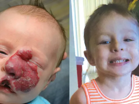 Birthmark Surgery Before & After 