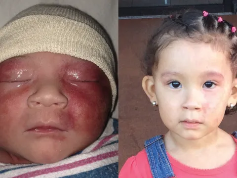 Birthmark Surgery Before & After 