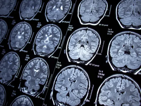 brain scan